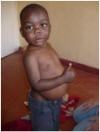Godfrey with distended belly